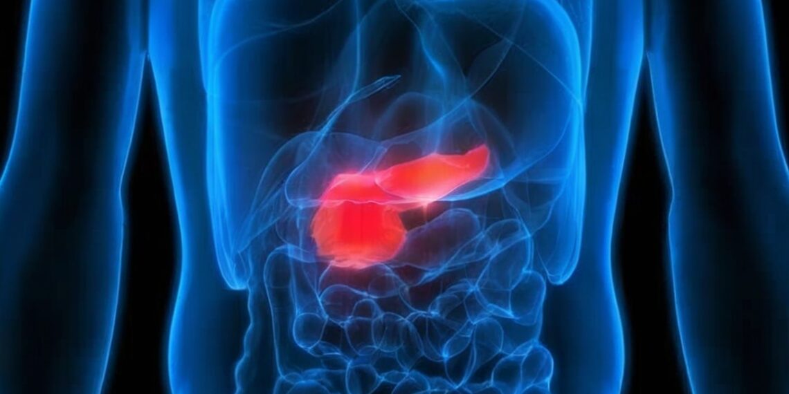 A Promising AI Pancreatic Cancer Detection Model Could Save Lives in Clinical Practice Soon