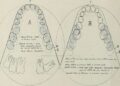 Deep Learning Algorithm Can Detect Occlusal Caries From Photographs